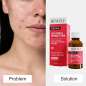 Pure Skin Anti-Pimple